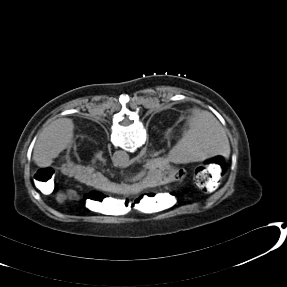 File:Anaplastic lymphoma - with CT biopsy (Radiopaedia 21643-21602 Axial non-contrast 12).jpg