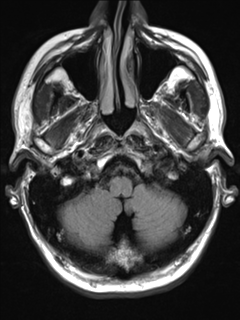 File:Anaplastic meningioma with recurrence (Radiopaedia 34452-35788 Axial T2 FLAIR 3).png