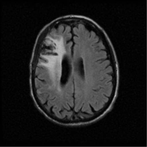 File:Anaplastic meningioma with recurrence (Radiopaedia 34452-35789 Axial FLAIR 16).png