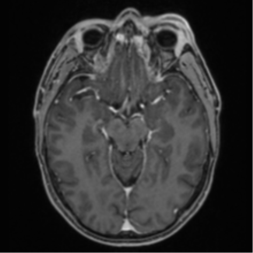 Anaplastic oligodendroglioma with skull fracture (Radiopaedia 74831-85845 Axial T1 C+ fat sat 24).png