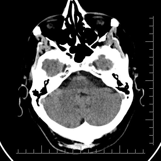 Aneurysm of posterior communicating artery (Radiopaedia 20188-20162 Axial non-contrast 11).jpg