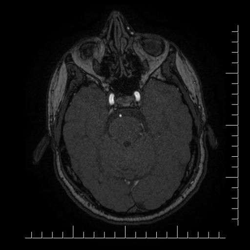 File:Aneurysm of posterior communicating artery (Radiopaedia 20188-20163 Axial MRA 41).jpg