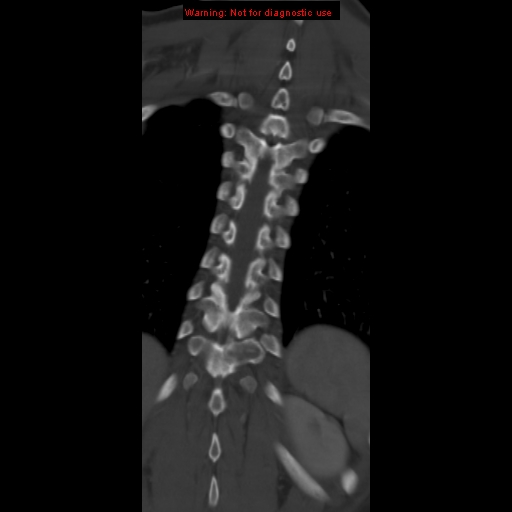 File:Aneurysmal bone cyst (Radiopaedia 9419-10102 Coronal bone window 17).jpg