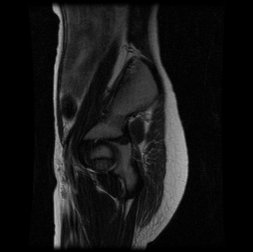 File:Aneurysmal bone cyst - sacrum (Radiopaedia 65190-74196 Sagittal T2 26).jpg
