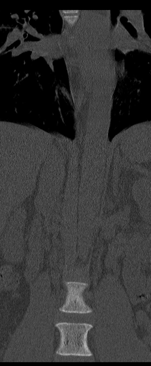 Aneurysmal bone cyst T11 (Radiopaedia 29294-29721 Coronal bone window 11).jpg