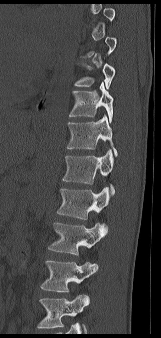 Aneurysmal bone cyst T11 (Radiopaedia 29294-29721 Sagittal bone window 29).jpg