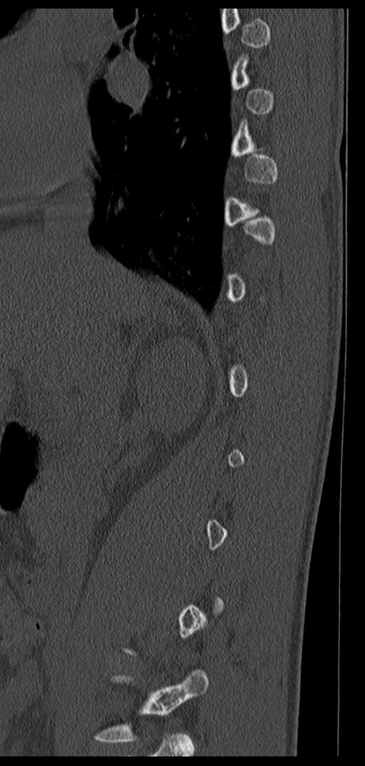 Aneurysmal bone cyst T11 (Radiopaedia 29294-29721 Sagittal bone window 58).jpg
