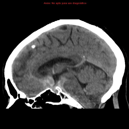 File:Aneurysmal subarachnoid hemorrhage (Radiopaedia 24740-24997 non-contrast 26).jpg