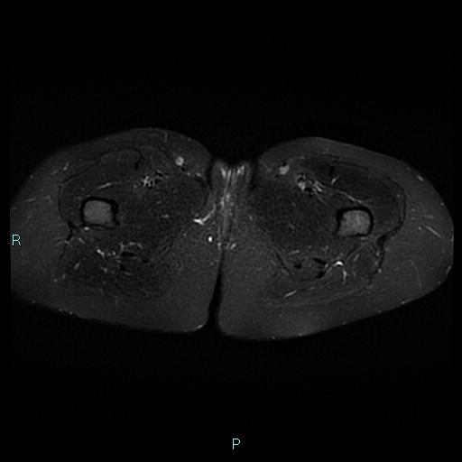Angioleiomyoma (Radiopaedia 85442-101078 Axial STIR 29).jpg