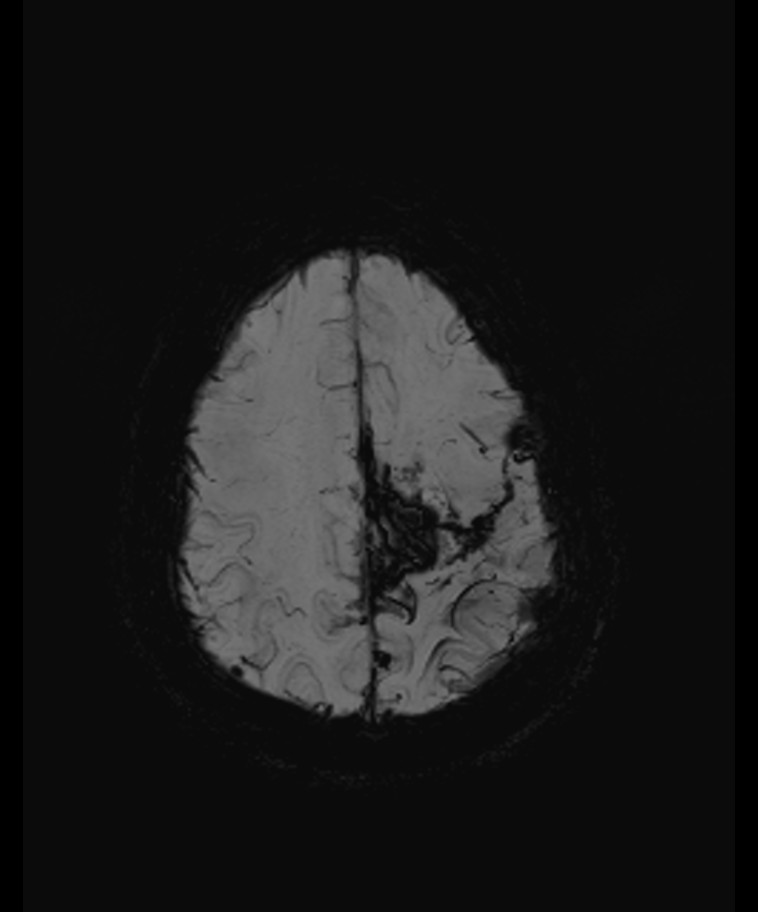 Angiomatous meningioma (Radiopaedia 79459-92579 E 52).jpg
