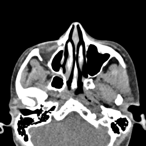 Angular dermoid cyst (Radiopaedia 88967-105790 Axial non-contrast 18).jpg