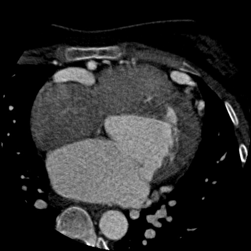 File:Anomalous left coronary artery from the pulmonary artery (ALCAPA) (Radiopaedia 40884-43586 A 37).jpg