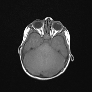 File:Anoxic brain injury (Radiopaedia 79165-92139 Axial T1 9).jpg