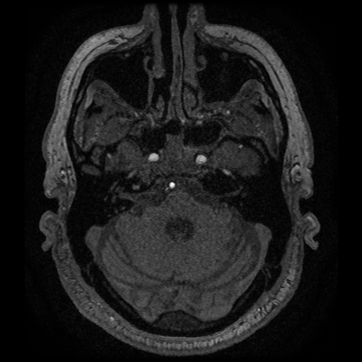 Anterior cerebral artery infarction (Radiopaedia 46794-51323 Axial MRA 28).jpg