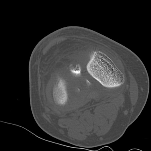 File:Anterior cruciate ligament avulsion fracture (Radiopaedia 58939-66194 Axial bone window 13).jpg