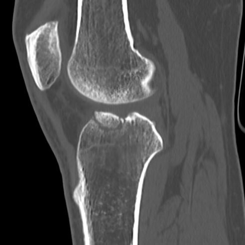 File:Anterior cruciate ligament avulsion fracture (Radiopaedia 58939-66194 Sagittal bone window 18).jpg