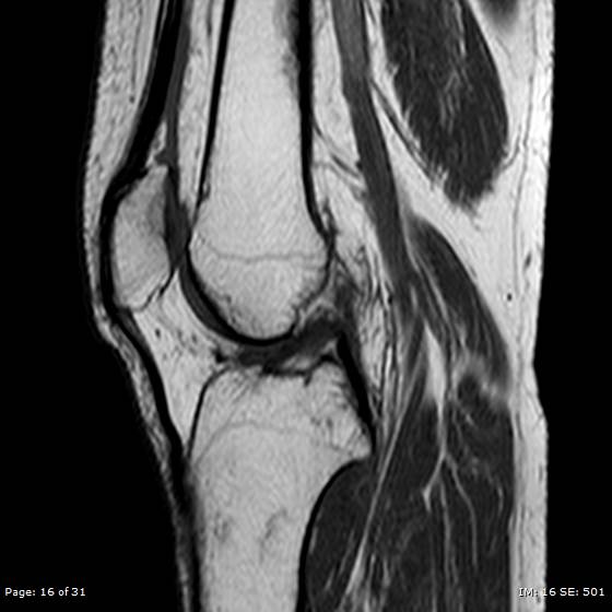 File:Anterior cruciate ligament tear (Radiopaedia 70783-80964 Sagittal T1 16).jpg