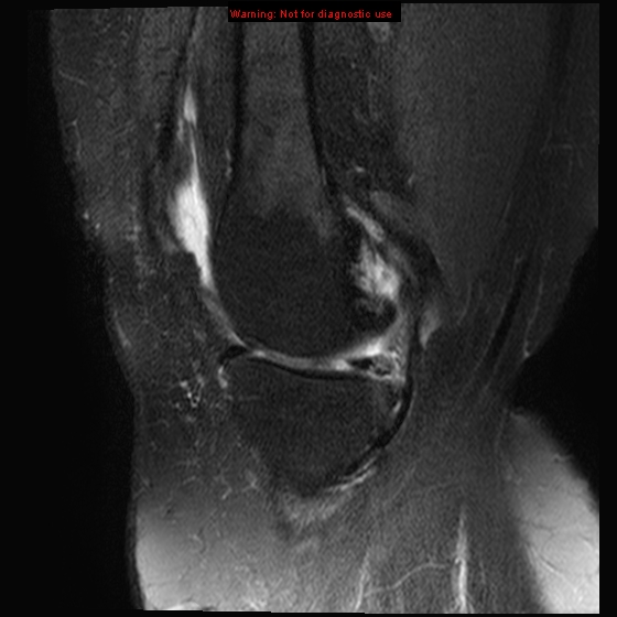 File:Anterior cruciate ligament tear - complete (Radiopaedia 12175-12514 Sagittal T2 fat sat 15).jpg