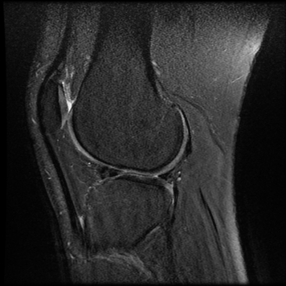 File:Anterior cruciate ligament tear with posteromedial corner injury, bucket-handle meniscal tear and chondral delamination (Radiopaedia 75501-86744 Sagittal PD fat sat 20).jpg