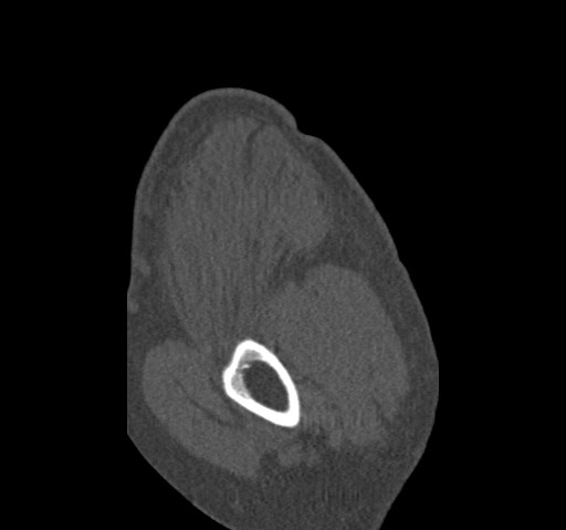 Anterior glenohumeral dislocation with Hill-Sachs lesion (Radiopaedia 62877-71249 Sagittal bone window 8).jpg