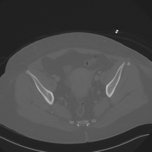 File:Anterior superior iliac spine avulsion fracture (Radiopaedia 44541-48244 Axial bone window 85).png