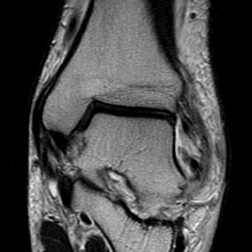 File:Anterior talofibular ligament rupture (Radiopaedia 15831-15484 Coronal T2 10).jpg