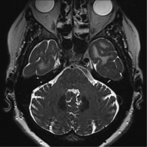 Anterior temporal pole cysts (Radiopaedia 46629-51102 Axial 11).png