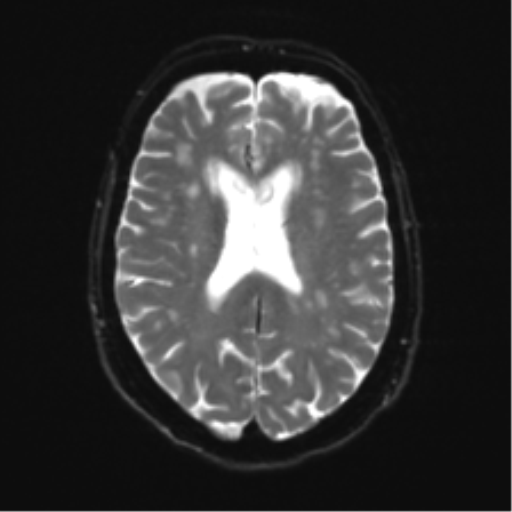 Anterior temporal pole cysts (Radiopaedia 46629-51102 Axial DWI 17).png