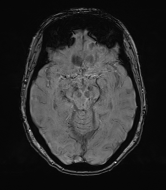 Anterior temporal pole cysts (Radiopaedia 46629-51102 Axial SWI 38).png