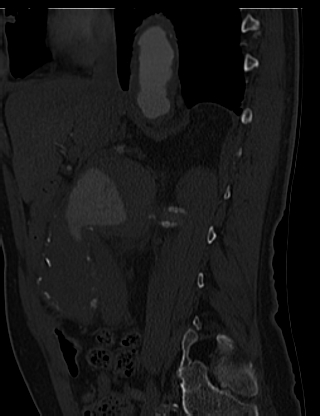 File:Anterior vertebral scalloping (abdominal aortic aneurysm) (Radiopaedia 66744-76067 Sagittal bone window 1).jpg