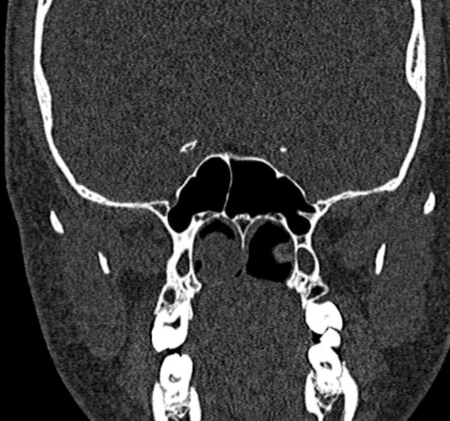 Antrochoanal polyp (Radiopaedia 30002-30554 Coronal bone window 59).jpg
