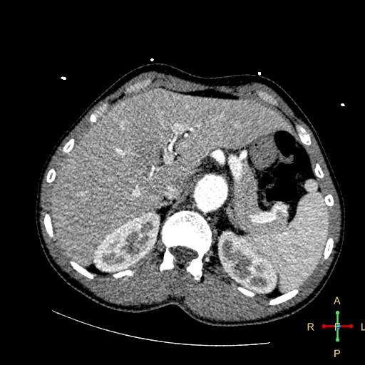 File:Aortic aneurysm and penetrating ulcer (Radiopaedia 23590-23704 A 30).jpg