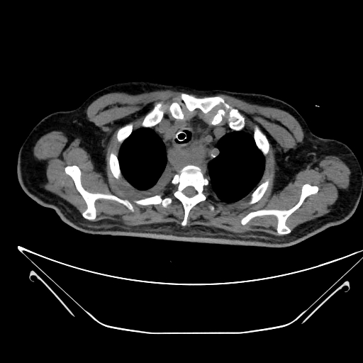 Aortic arch aneurysm (Radiopaedia 84109-99365 Axial non-contrast 50).jpg