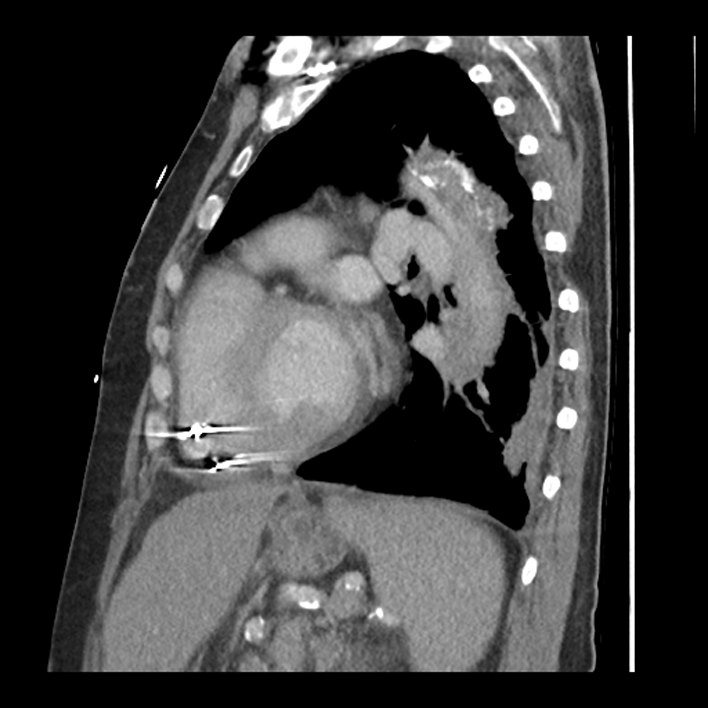 Aortic arch graft infection (FDG PET-CT) (Radiopaedia 71975-82437 C 46).jpg