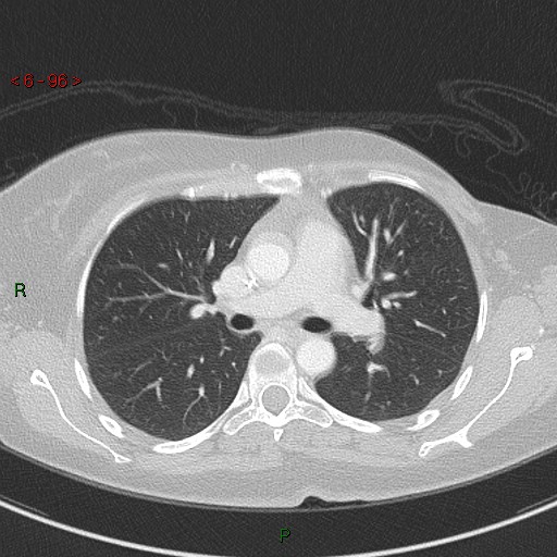 Aortic arch origin of left vertebral artery (Radiopaedia 51520-57286 Axial lung window 96).jpg