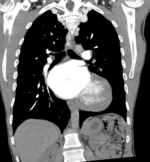 Aortic coarctation with aneurysm (Radiopaedia 74818-85828 C 69).jpg