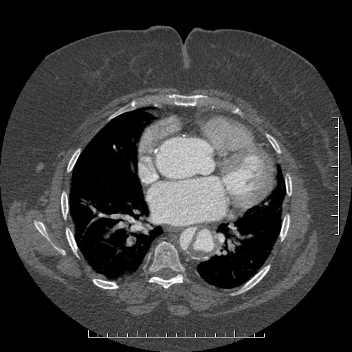 File:Aortic dissection- Stanford A (Radiopaedia 35729-37268 A 54).jpg