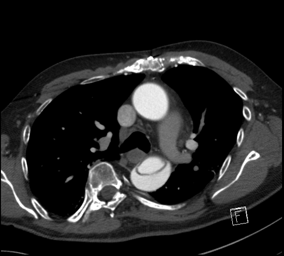 Aortic dissection (CTPA) (Radiopaedia 75506-86750 A 37).jpg