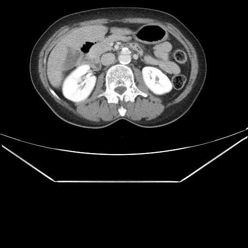 File:Aortic dissection (Radiopaedia 25350-25604 C 62).jpg