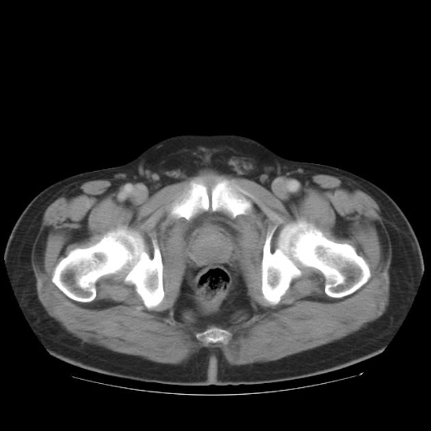 Aortic dissection (Radiopaedia 44411-48061 C 104).jpg