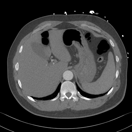 File:Aortic dissection (Radiopaedia 50763-56234 A 71).png