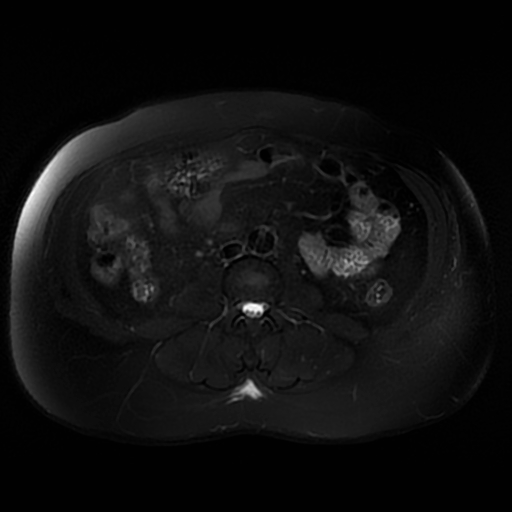 File:Aortic dissection (Radiopaedia 57969-64956 Axial T2 fat sat 42).jpg