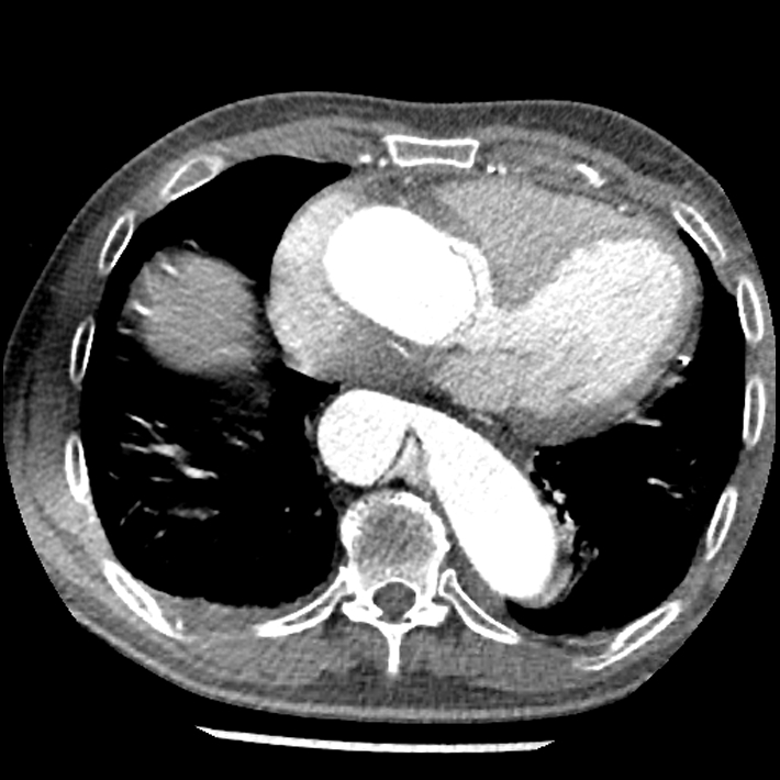 Aortic dissection - DeBakey Type I-Stanford A (Radiopaedia 79863-93115 A 27).jpg