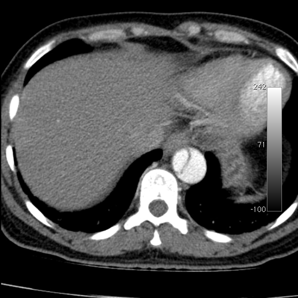 Aortic dissection - Stanford type A (Radiopaedia 29247-29659 A 63).jpg