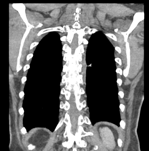 File:Aortic dissection - Stanford type B (Radiopaedia 50171-55512 B 70).png