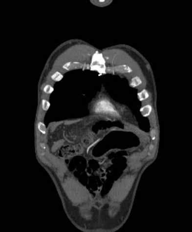 Aortic dissection - Stanford type B (Radiopaedia 73648-84437 B 15).jpg