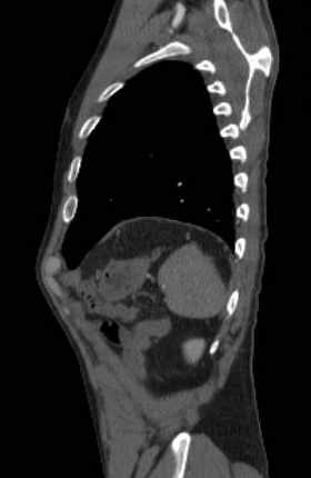File:Aortic dissection - Stanford type B (Radiopaedia 73648-84437 C 21).jpg