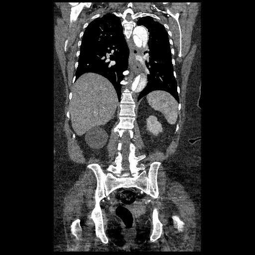File:Aortic dissection - Stanford type B (Radiopaedia 88281-104910 B 58).jpg