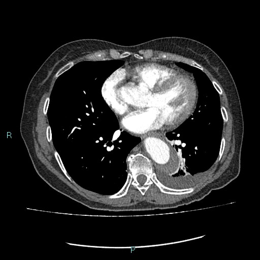 File:Aortic dissection extended to lusory artery (Radiopaedia 43686-47136 B 9).jpg