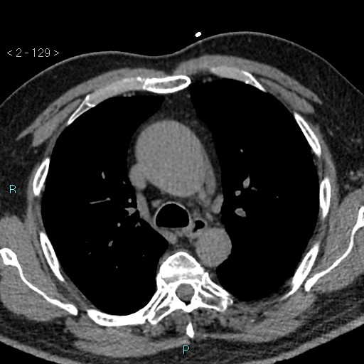 File:Aortic intramural hematoma (Radiopaedia 48463-53380 Axial non-contrast 57).jpg